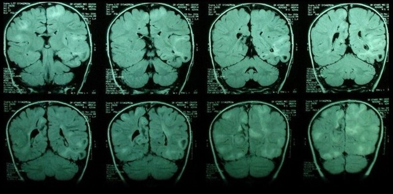 Brain MRI Scans — Green