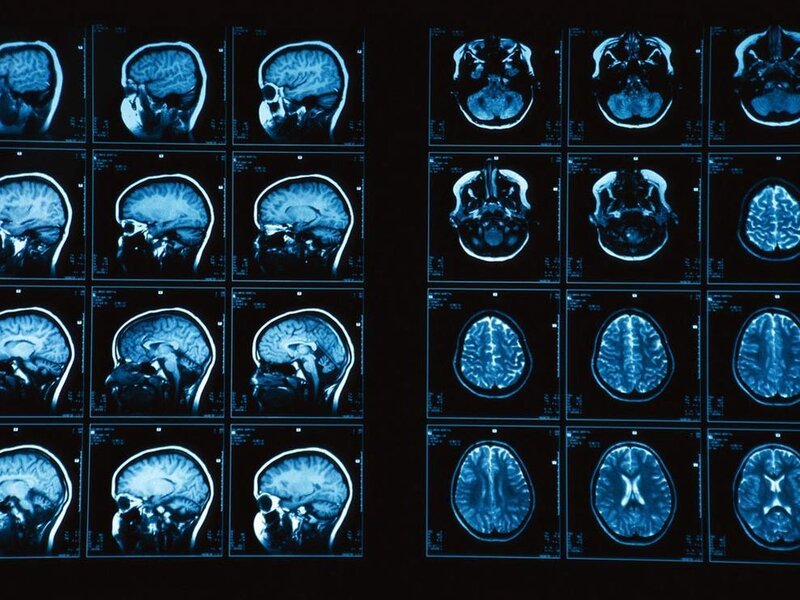 Brain MRI Scans