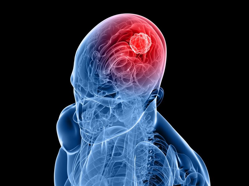 Brain Tumor in Head
