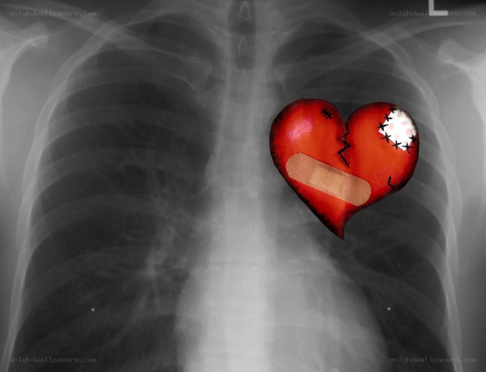 Broken heart on chest X-ray