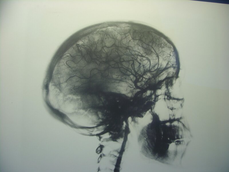 Cerebral angiogram X-ray