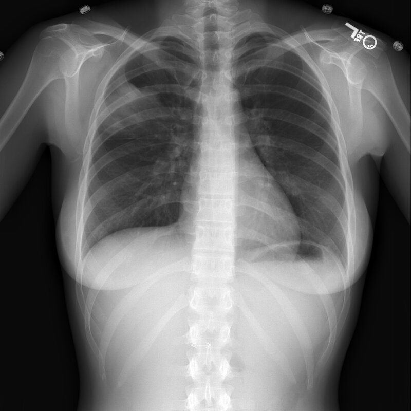 Chest X-ray of a person