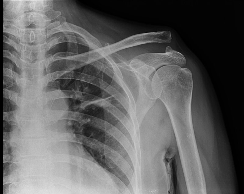 Chest X-ray of Shoulder