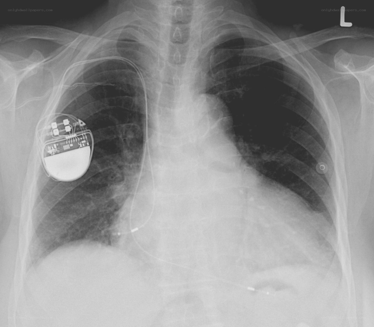 Chest X-ray with pacemaker
