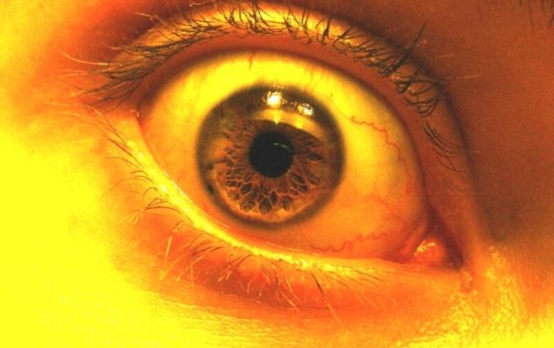 close-up of a yellow-tinged eye