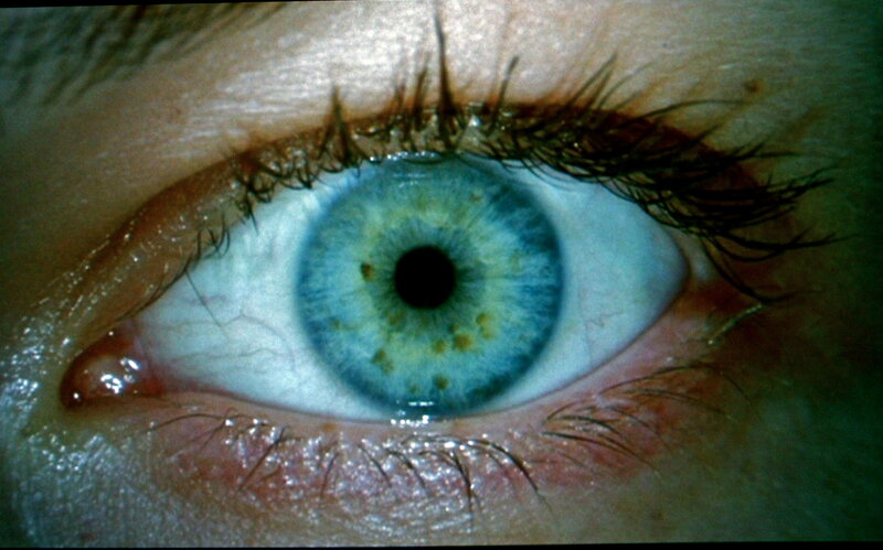close-up of an eye with lesions