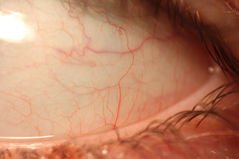 close-up of eye blood vessels