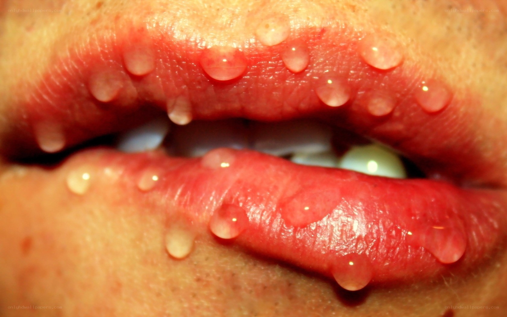 close-up of lips with blisters