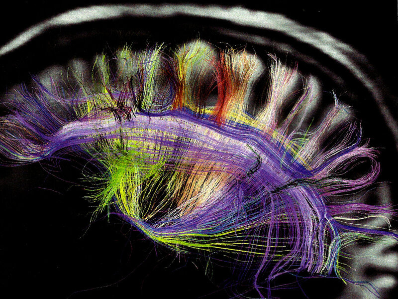 Colored Fibers in Eye