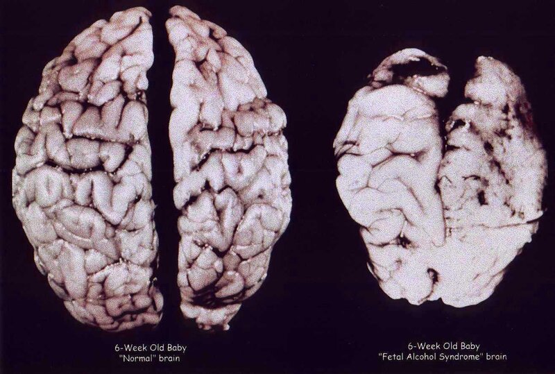 Comparison of Baby Brains