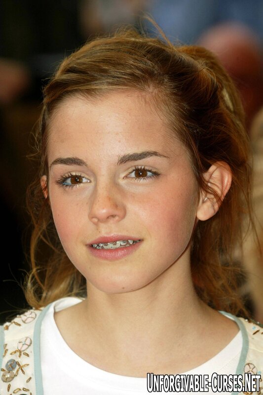 Emma Watson with braces