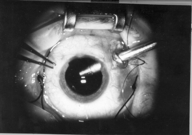 Eye surgery in progress