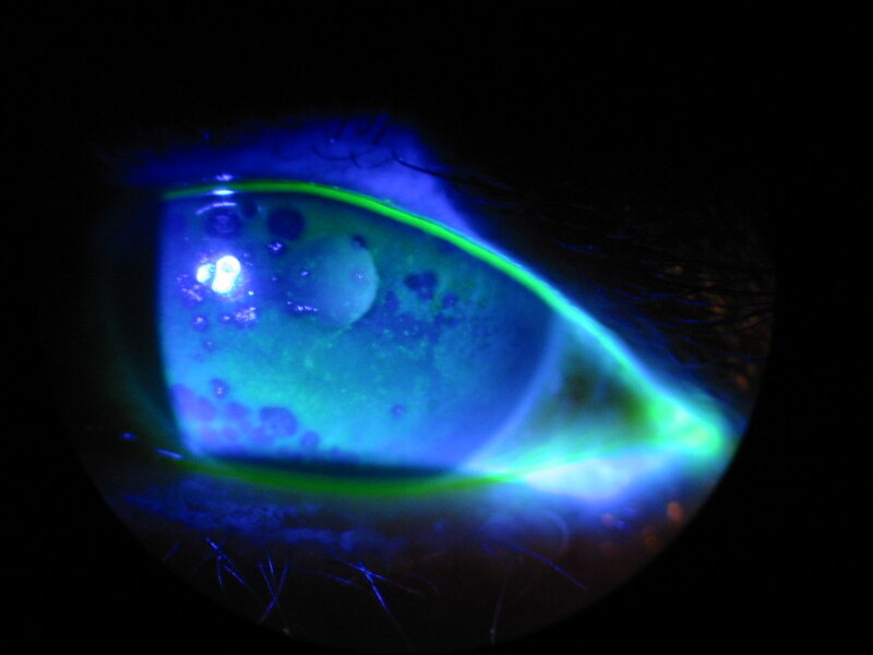 eye under fluorescent light