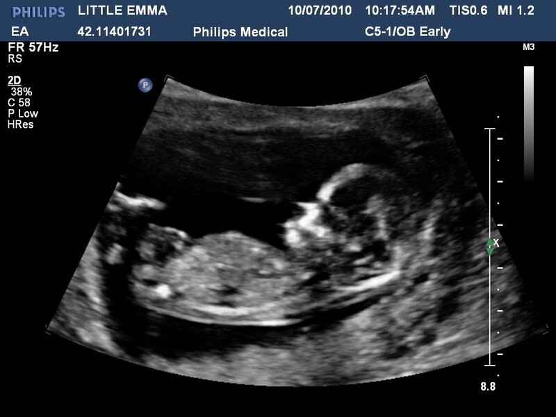 Fetus in Ultrasound Scan