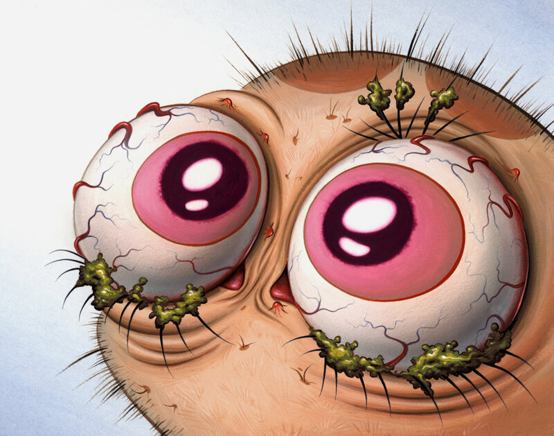 Grossly Inflamed Eyes