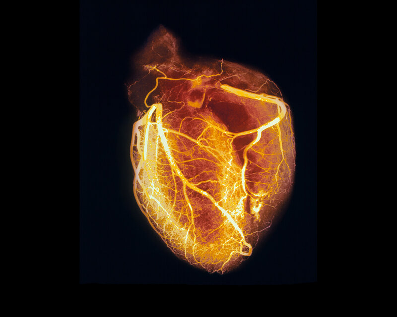 Heart with coronary arteries