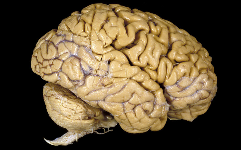 Human brain specimen