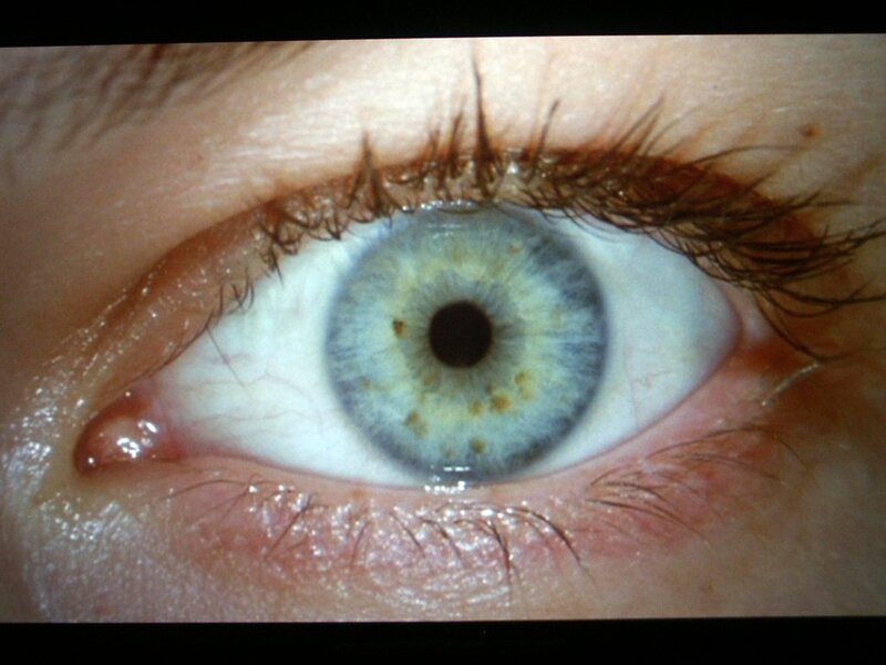 Human Eye with Lesions