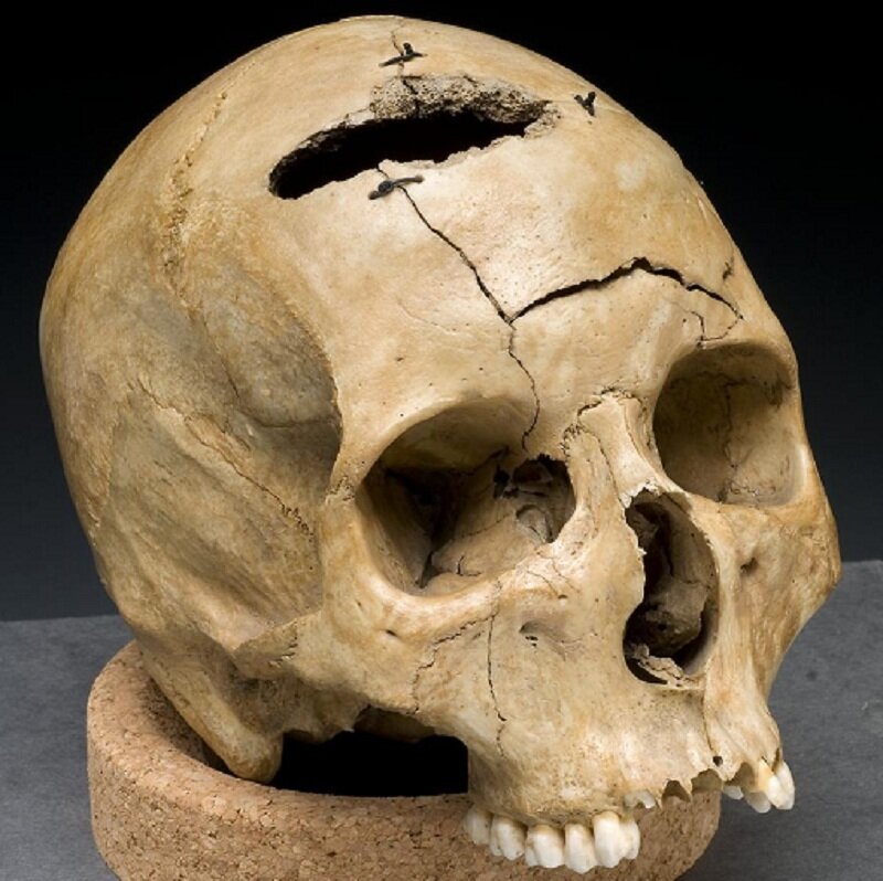 Human Skull with Trepanation