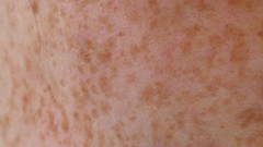 Freckles skin cancer