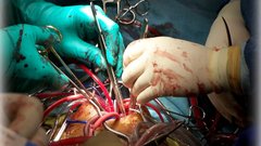 Heart clamps amp tubing