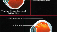 Retinal Detachment high