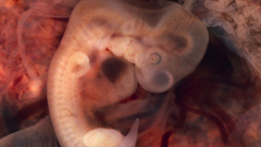 Tubal pregnancy ) With