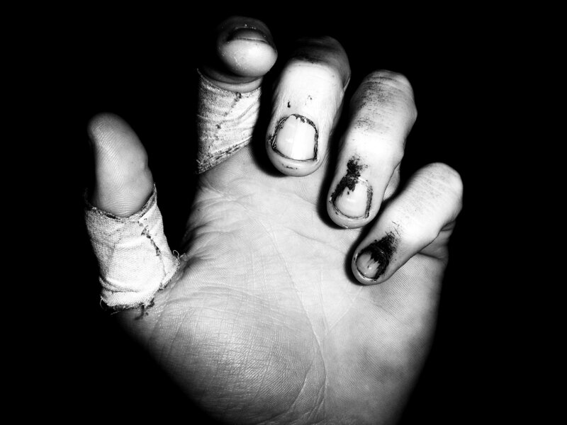 injured hand with bandages