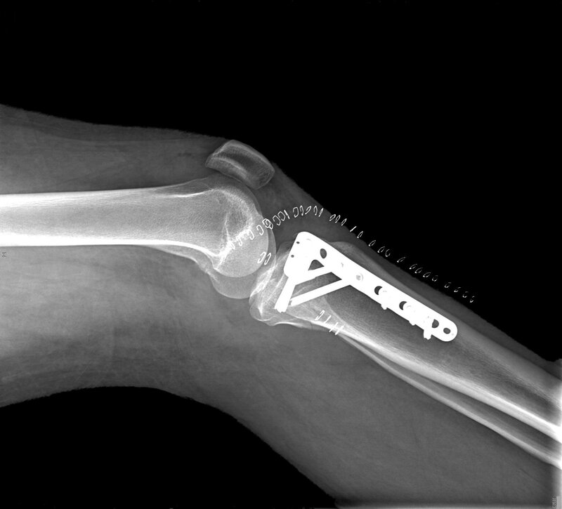 Knee with Surgical Plate