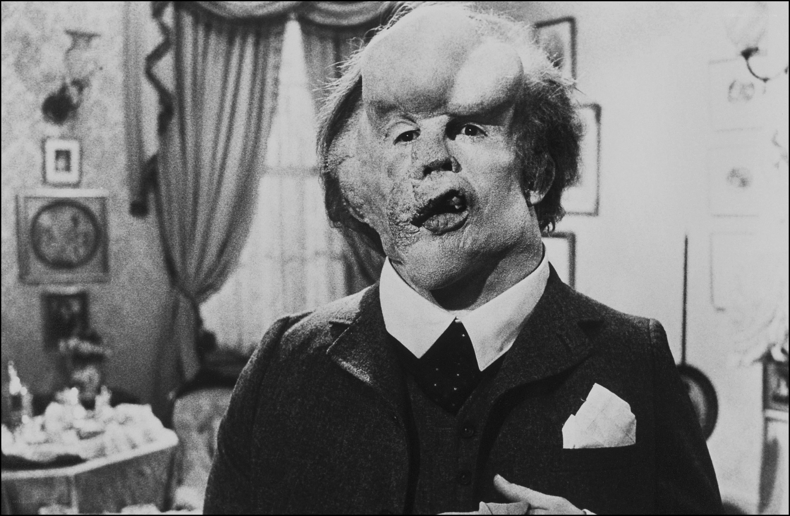 man with facial deformity in suit