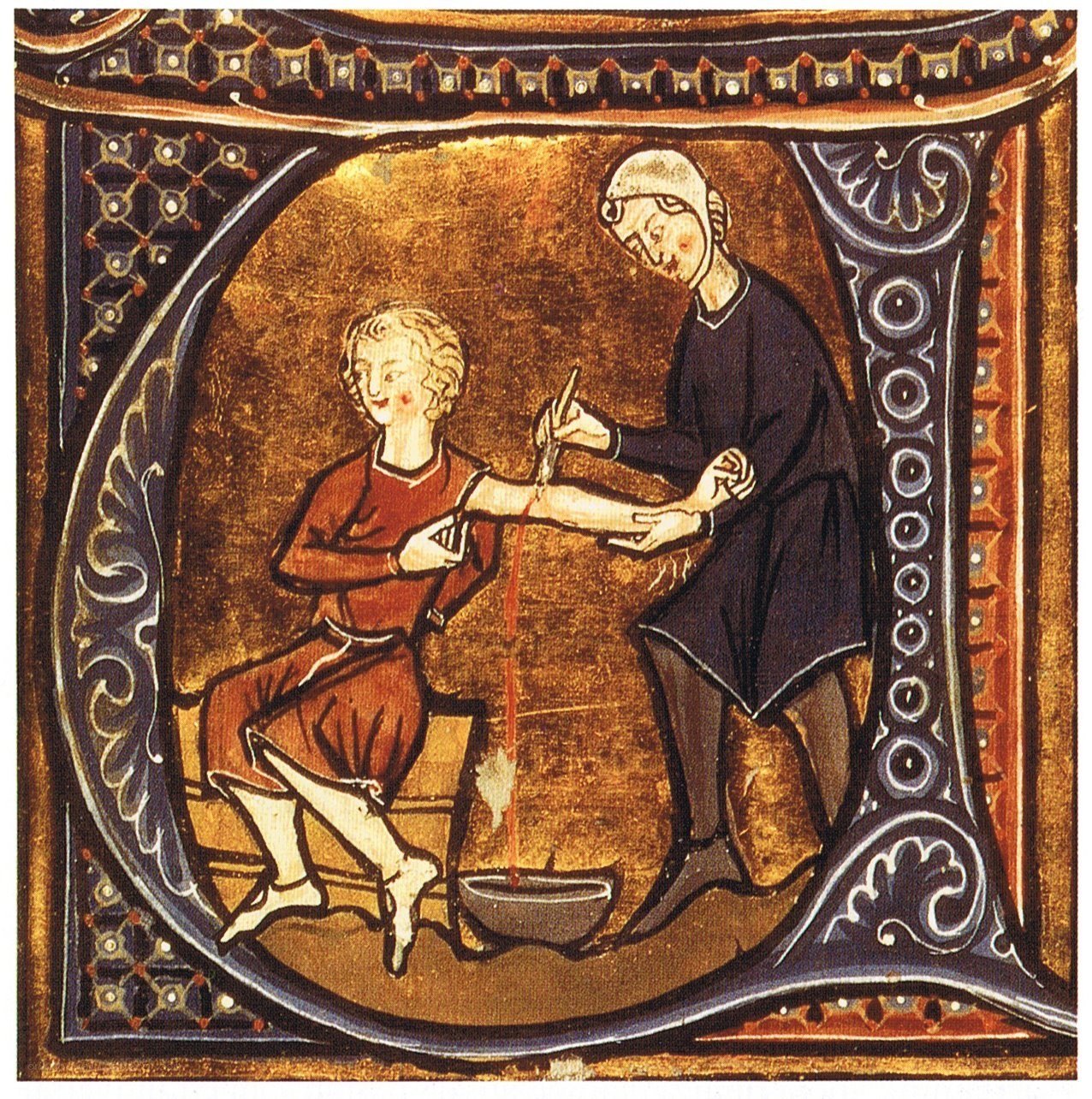 Medieval bloodletting procedure