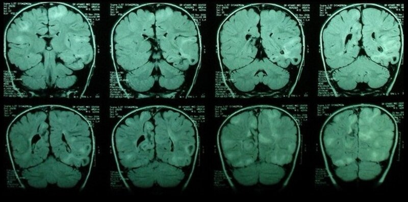 MRI brain scan images