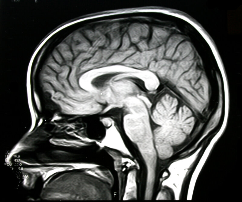 MRI brain scan sagittal view