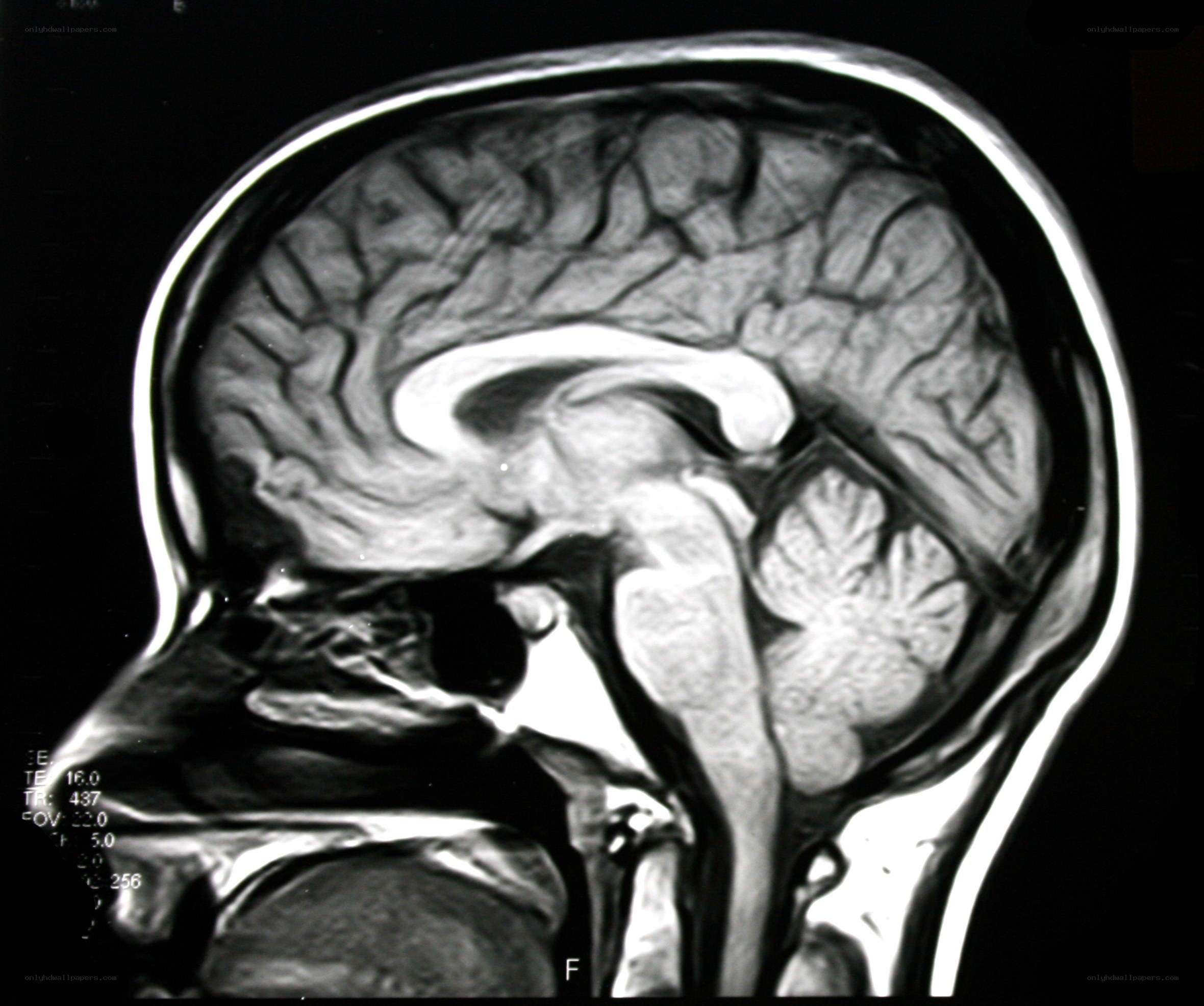 MRI brain scan sagittal view