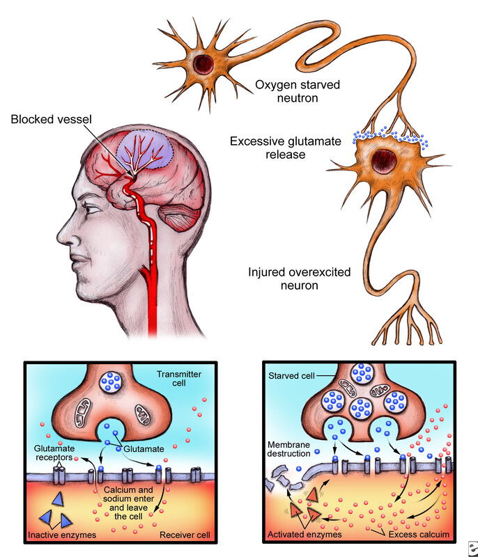 Neuron damage from stroke