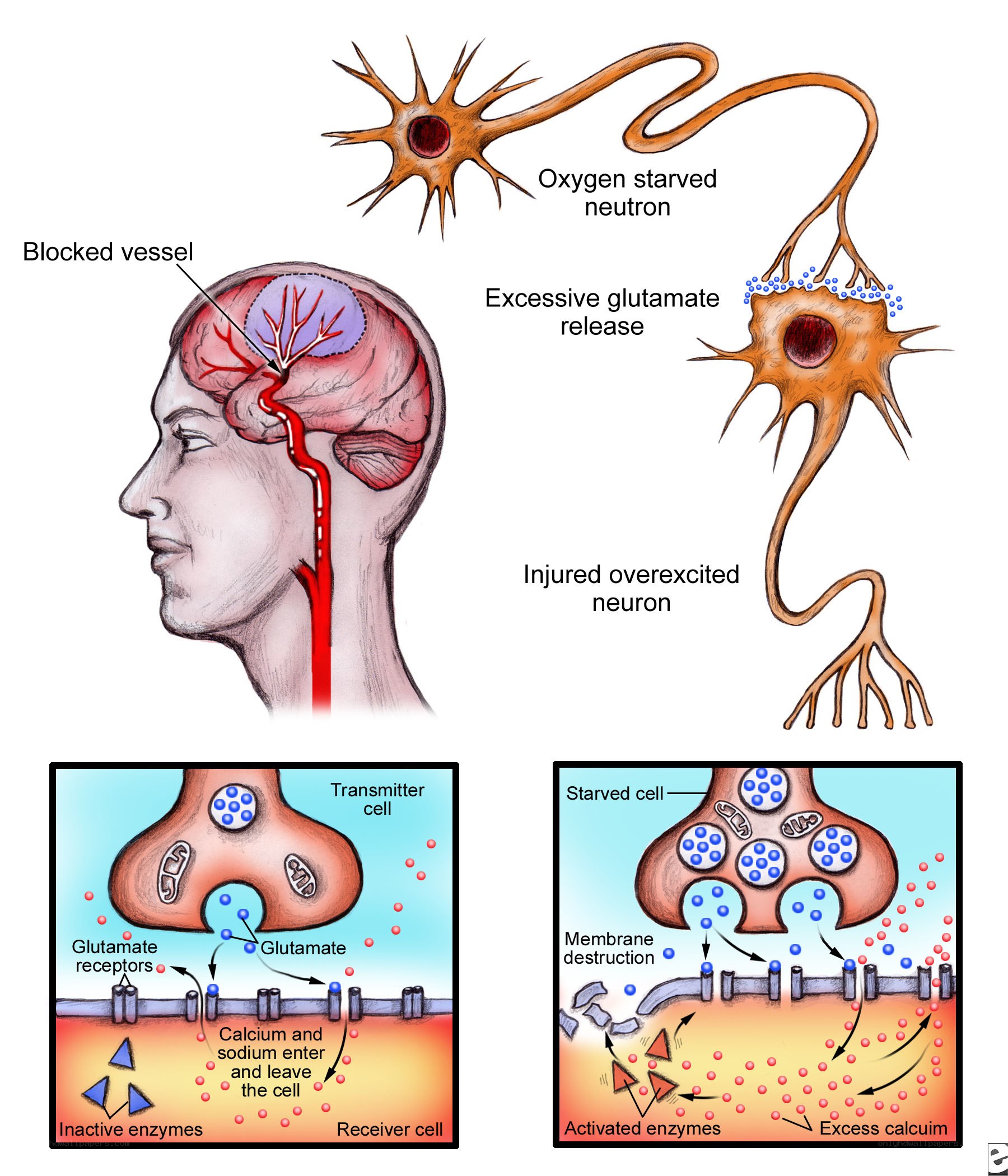Neuron damage from stroke