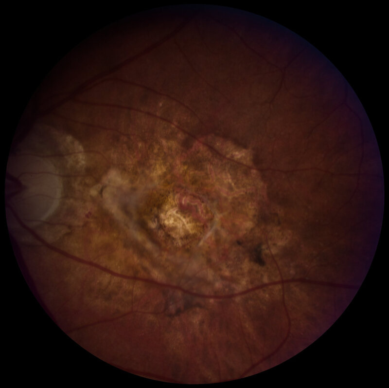 Retinal fundus image