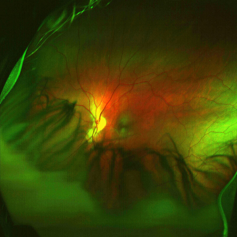 Retinal fundus photograph