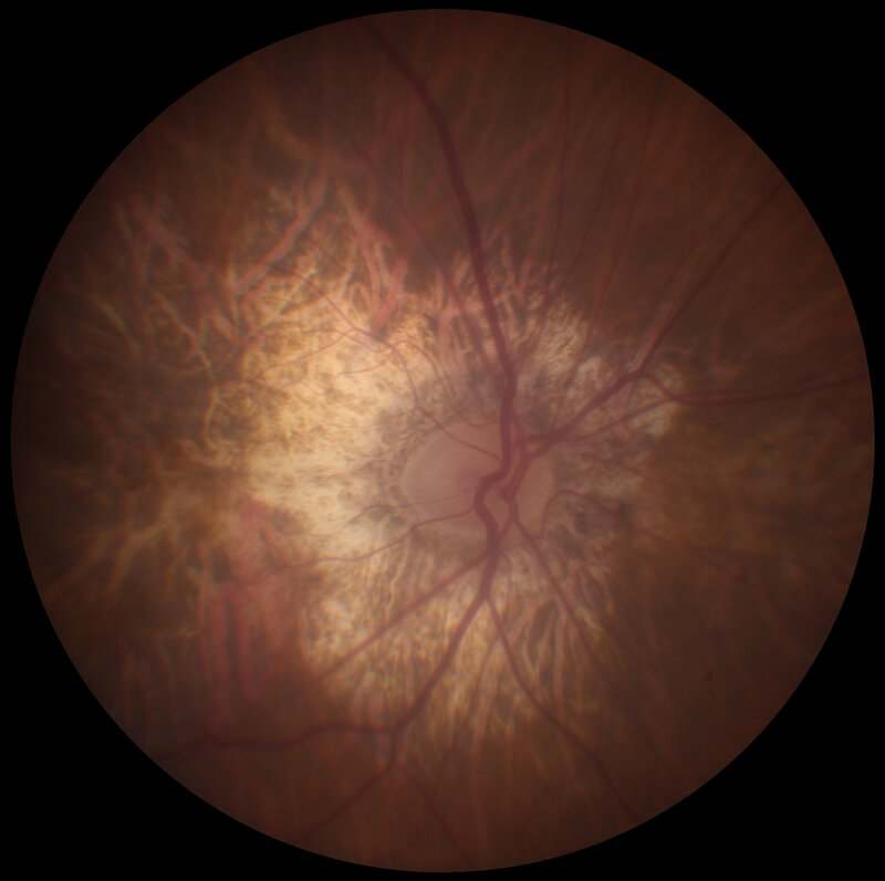 Retinal fundus photograph