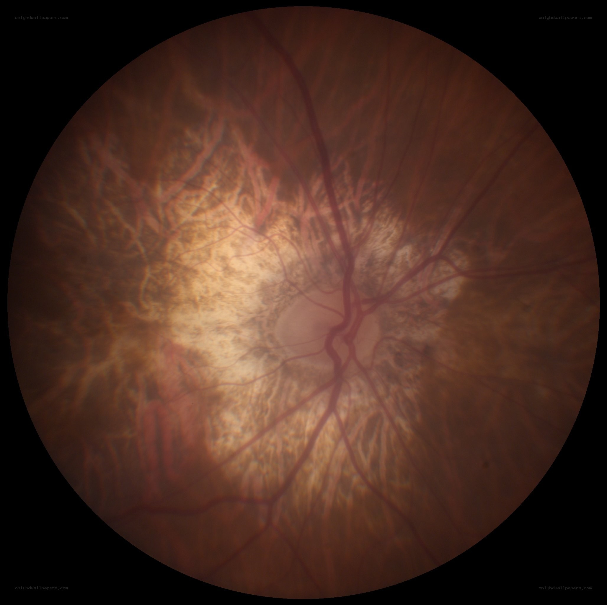 Retinal fundus photograph