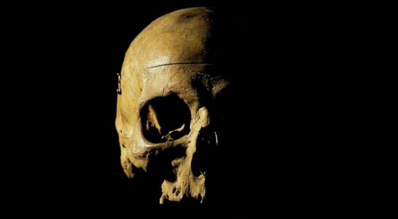 skull with surgical incision