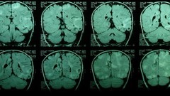 Brain medicine skulls doctors scans diseases MRI