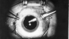 Close-up eyes surgery