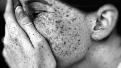 Freckles