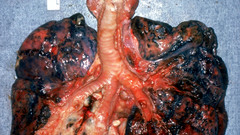 Lungs cancer smoking diseases