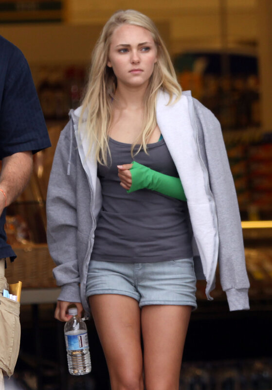 woman with green cast walking