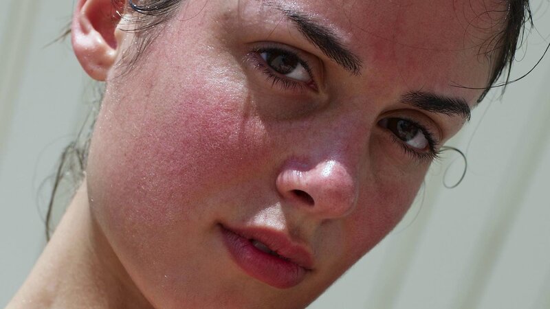 Woman with Sunburned Face