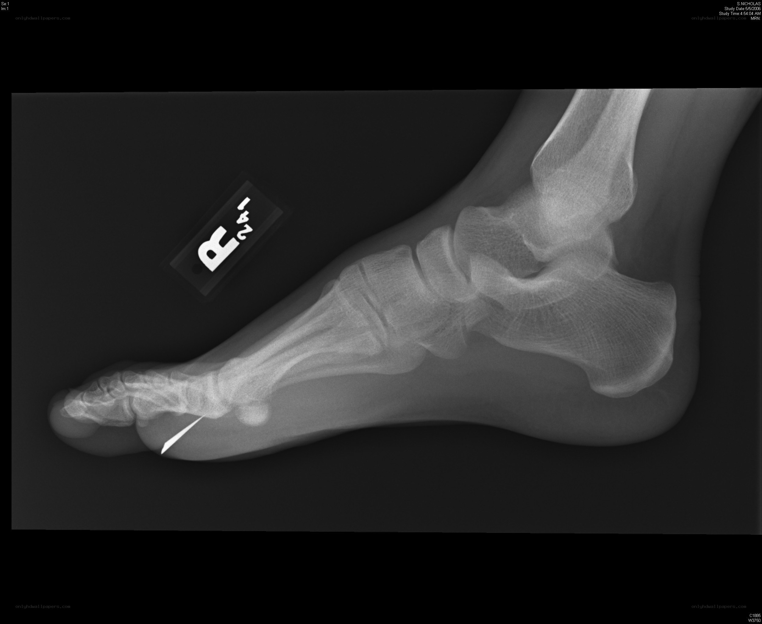 X-ray of a foot