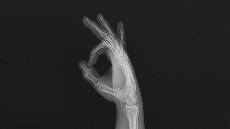 X-ray of a Hand — Black
