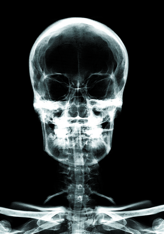 X-ray of a human skull